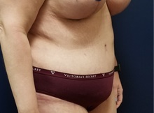 Tummy Tuck After Photo by Noel Natoli, MD, FACS; East Hills, NY - Case 43358
