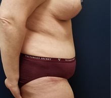 Tummy Tuck After Photo by Noel Natoli, MD, FACS; East Hills, NY - Case 43358