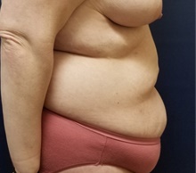 Tummy Tuck Before Photo by Noel Natoli, MD, FACS; East Hills, NY - Case 43358