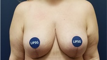 Breast Lift After Photo by Noel Natoli, MD, FACS; East Hills, NY - Case 43359