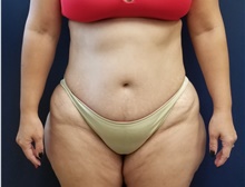 Liposuction Before Photo by Noel Natoli, MD, FACS; East Hills, NY - Case 43363