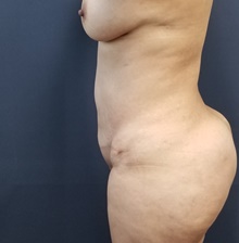 Liposuction After Photo by Noel Natoli, MD, FACS; East Hills, NY - Case 43363