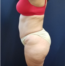 Liposuction Before Photo by Noel Natoli, MD, FACS; East Hills, NY - Case 43363