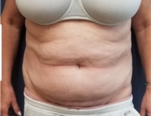 Liposuction Before Photo by Noel Natoli, MD, FACS; East Hills, NY - Case 43364