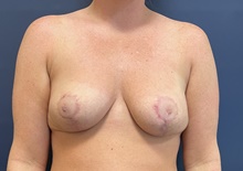 Breast Reduction After Photo by Noel Natoli, MD, FACS; East Hills, NY - Case 44863