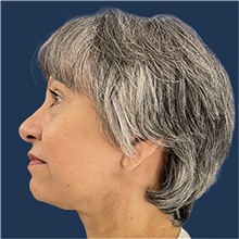Facelift After Photo by Noel Natoli, MD, FACS; East Hills, NY - Case 44864