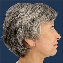 Facelift After Photo by Noel Natoli, MD, FACS; East Hills, NY - Case 44864