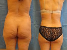Tummy Tuck After Photo by Traci Temmen, MD; Tampa, FL - Case 28865