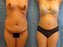 Tummy Tuck Before Photo by Traci Temmen, MD; Tampa, FL - Case 28865