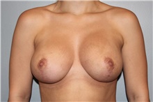 Breast Lift After Photo by Keyianoosh Paydar, MD, FACS; Newport Beach, CA - Case 45941