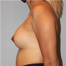 Breast Augmentation After Photo by Keyian Paydar, MD, FACS; Newport Beach, CA - Case 45943