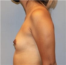 Breast Augmentation Before Photo by Keyian Paydar, MD, FACS; Newport Beach, CA - Case 45943