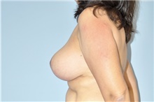 Breast Reduction After Photo by Keyian Paydar, MD, FACS; Newport Beach, CA - Case 46581