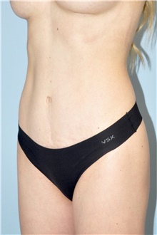 Tummy Tuck After Photo by Keyian Paydar, MD, FACS; Newport Beach, CA - Case 46583