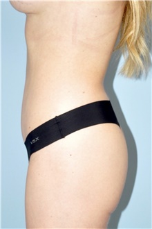 Tummy Tuck After Photo by Keyian Paydar, MD, FACS; Newport Beach, CA - Case 46583