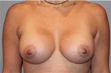 Breast Augmentation After Photo by Keyian Paydar, MD, FACS; Newport Beach, CA - Case 46621