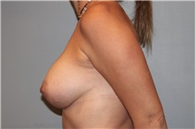 Breast Augmentation After Photo by Keyian Paydar, MD, FACS; Newport Beach, CA - Case 46621