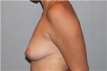 Breast Augmentation Before Photo by Keyian Paydar, MD, FACS; Newport Beach, CA - Case 46621