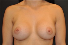 Breast Augmentation After Photo by Keyian Paydar, MD, FACS; Newport Beach, CA - Case 46622