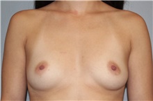 Breast Augmentation Before Photo by Keyian Paydar, MD, FACS; Newport Beach, CA - Case 46622
