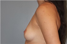 Breast Augmentation Before Photo by Keyian Paydar, MD, FACS; Newport Beach, CA - Case 46622