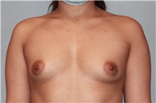 Breast Augmentation Before Photo by Keyian Paydar, MD, FACS; Newport Beach, CA - Case 46623