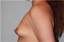 Breast Augmentation Before Photo by Keyian Paydar, MD, FACS; Newport Beach, CA - Case 46623