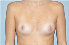 Breast Augmentation Before Photo by Keyian Paydar, MD, FACS; Newport Beach, CA - Case 46628