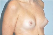 Breast Augmentation Before Photo by Keyian Paydar, MD, FACS; Newport Beach, CA - Case 46628
