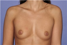 Breast Augmentation Before Photo by Keyian Paydar, MD, FACS; Newport Beach, CA - Case 46629