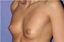 Breast Augmentation Before Photo by Keyian Paydar, MD, FACS; Newport Beach, CA - Case 46629
