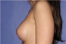 Breast Augmentation After Photo by Keyian Paydar, MD, FACS; Newport Beach, CA - Case 46629