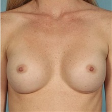 Breast Augmentation After Photo by Keyian Paydar, MD, FACS; Newport Beach, CA - Case 46654