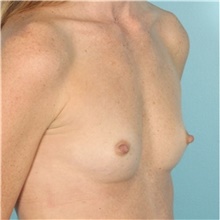 Breast Augmentation Before Photo by Keyian Paydar, MD, FACS; Newport Beach, CA - Case 46654
