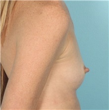 Breast Augmentation Before Photo by Keyian Paydar, MD, FACS; Newport Beach, CA - Case 46654