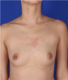 Breast Augmentation Before Photo by Keyian Paydar, MD, FACS; Newport Beach, CA - Case 46656
