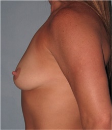 Breast Augmentation Before Photo by Keyian Paydar, MD, FACS; Newport Beach, CA - Case 46658