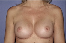 Breast Augmentation After Photo by Keyian Paydar, MD, FACS; Newport Beach, CA - Case 46659