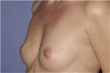 Breast Augmentation Before Photo by Keyian Paydar, MD, FACS; Newport Beach, CA - Case 46659
