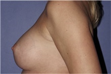 Breast Augmentation After Photo by Keyian Paydar, MD, FACS; Newport Beach, CA - Case 46659
