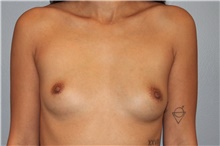 Breast Augmentation Before Photo by Keyian Paydar, MD, FACS; Newport Beach, CA - Case 46661