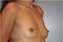 Breast Augmentation Before Photo by Keyian Paydar, MD, FACS; Newport Beach, CA - Case 46661