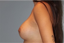 Breast Augmentation After Photo by Keyian Paydar, MD, FACS; Newport Beach, CA - Case 46661