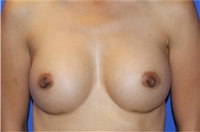 Breast Augmentation After Photo by Keyian Paydar, MD, FACS; Newport Beach, CA - Case 46662