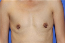 Breast Augmentation Before Photo by Keyian Paydar, MD, FACS; Newport Beach, CA - Case 46662