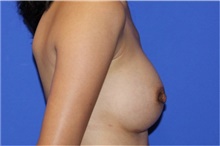 Breast Augmentation After Photo by Keyian Paydar, MD, FACS; Newport Beach, CA - Case 46662