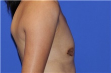 Breast Augmentation Before Photo by Keyian Paydar, MD, FACS; Newport Beach, CA - Case 46662