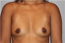 Breast Augmentation Before Photo by Keyian Paydar, MD, FACS; Newport Beach, CA - Case 46804