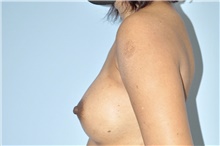 Breast Augmentation After Photo by Keyian Paydar, MD, FACS; Newport Beach, CA - Case 46804