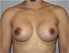 Breast Augmentation After Photo by Keyian Paydar, MD, FACS; Newport Beach, CA - Case 46805